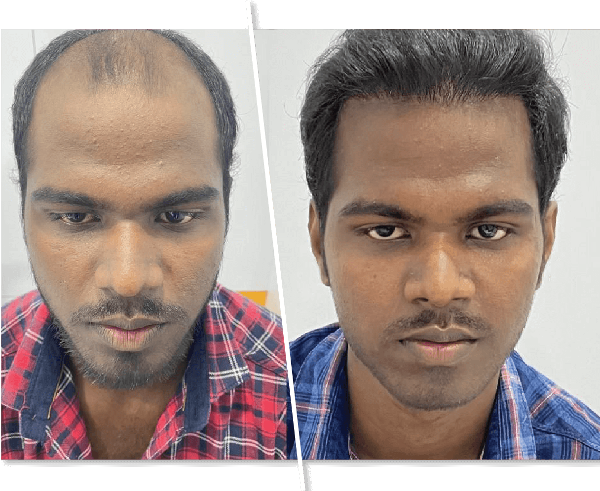 Hair-Transplantation_1